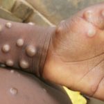 Trois cas de l'épidémie de Monkeypox détectés dans la zone de santé de N'Sele