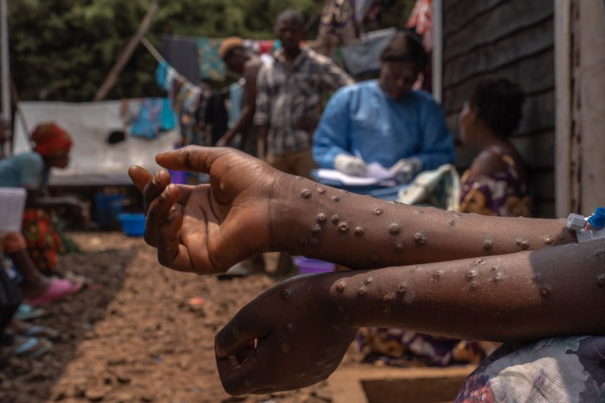 Les écoles appelées à renforcer les mesures de prévention contre le MPOX