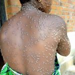 16 cas enregistrés d’épidémie monkeypox dans 4 zones de santé