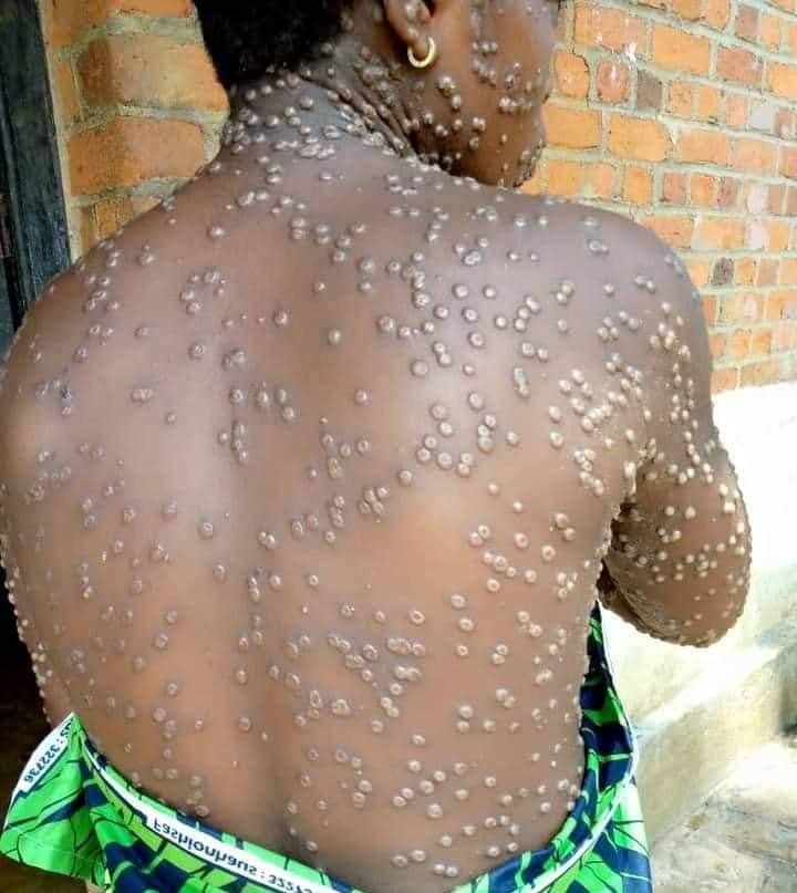 16 cas enregistrés d’épidémie monkeypox dans 4 zones de santé