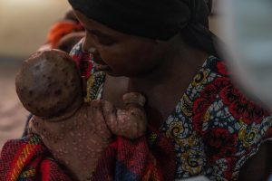 Les écoles appelées à renforcer les mesures de prévention contre le MPOX