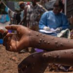 Lancement de la campagne de vaccination pour lutter contre l'épidémie Mpox