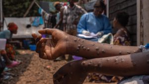 Lancement de la campagne de vaccination pour lutter contre l'épidémie Mpox