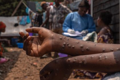 Lancement de la campagne de vaccination pour lutter contre l'épidémie Mpox