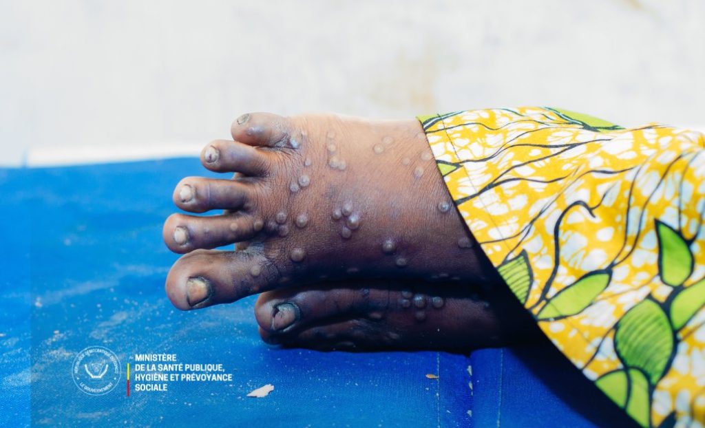 La Campagne de vaccination contre Mpox annoncé pour le 07 octobre